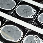 Les innovations technologiques en médecine sportive pour traiter les tendinites calcifiantes 12 découvrez les dernières innovations et avancées en médecine du sport grâce à la technologie. explorez comment les outils et techniques modernes améliorent la performance, la récupération et la santé des athlètes.