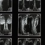découvrez les bienfaits de la décompression spinale : une méthode innovante pour soulager les douleurs dorsales, améliorer la posture et favoriser la guérison des disques intervertébraux. explorez nos traitements adaptés pour retrouver une colonne vertébrale en pleine santé.