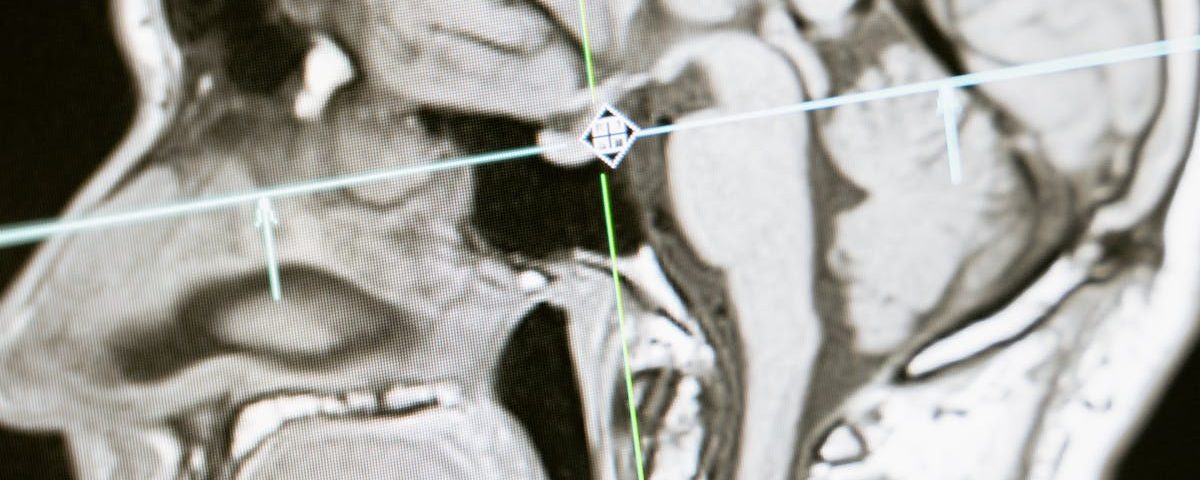 Médecine fonctionnelle et prévention des maladies neurodégénératives : des solutions éprouvées 4 découvrez la médecine fonctionnelle, une approche holistique qui cible les causes profondes des maladies pour favoriser un mieux-être durable. apprenez comment cette discipline innovante allie science moderne et pratiques traditionnelles pour optimiser votre santé globale.