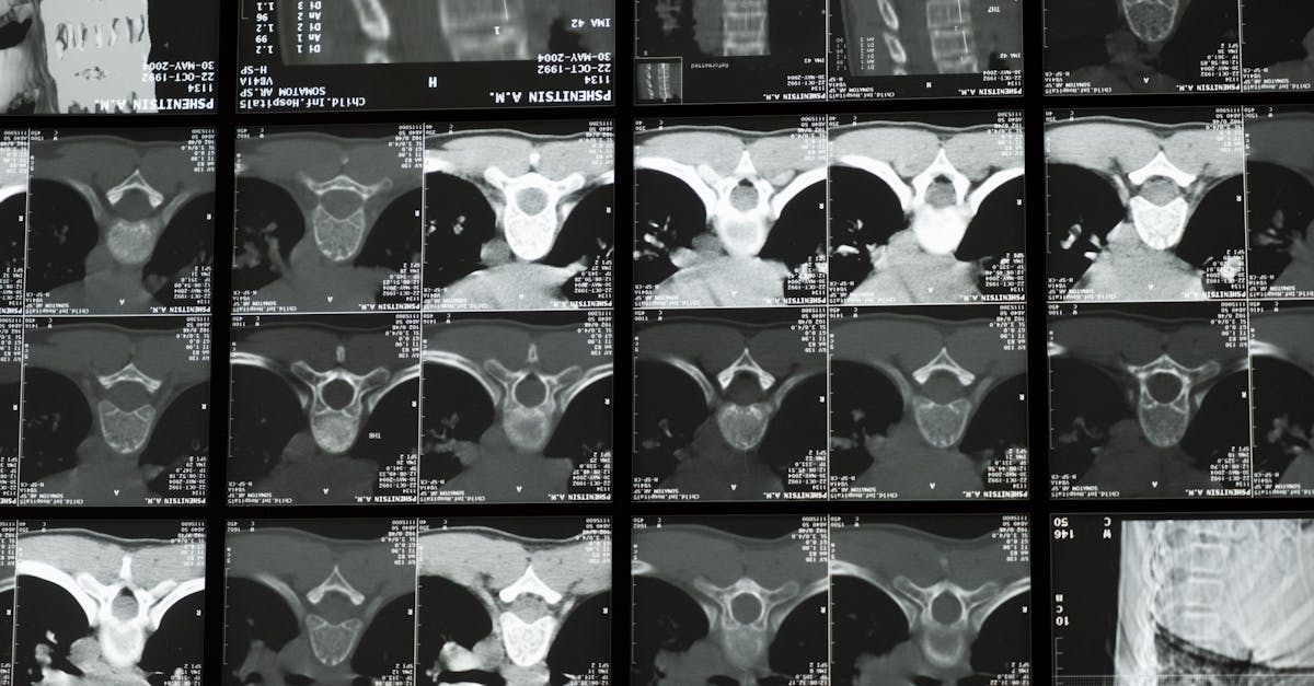 découvrez la décompression vertébrale, une technique médicale visant à soulager la douleur dorsale en réduisant la pression sur la colonne vertébrale. améliorez votre confort et mobilité grâce à des traitements adaptés.